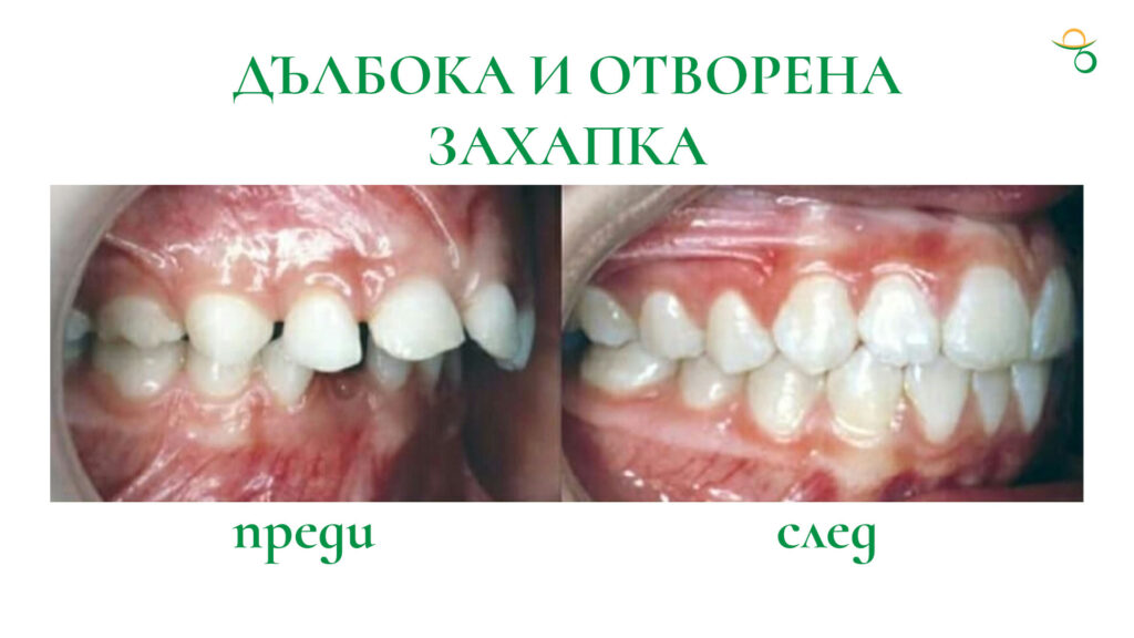 Дълбока и отворена захапка преди и след ортодонтско лечение | зъболекар Хасково